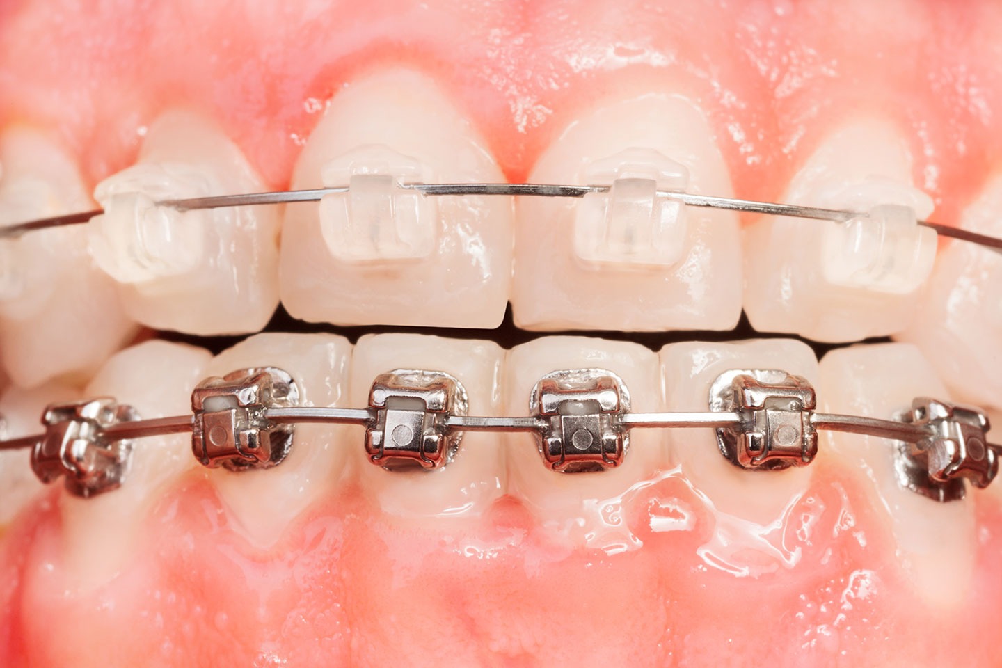 Brackets estéticos para alinear tu sonrisa con discreción y confianza